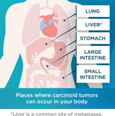 Diagram of the lung, liver, stomach, and large and small intestines to illustrate the places where carcinoid tumors can occur in the body